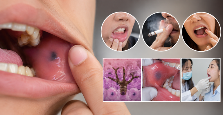 Black Spot Inside Cheek